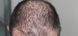 Haartransplantation ohne Rasieren