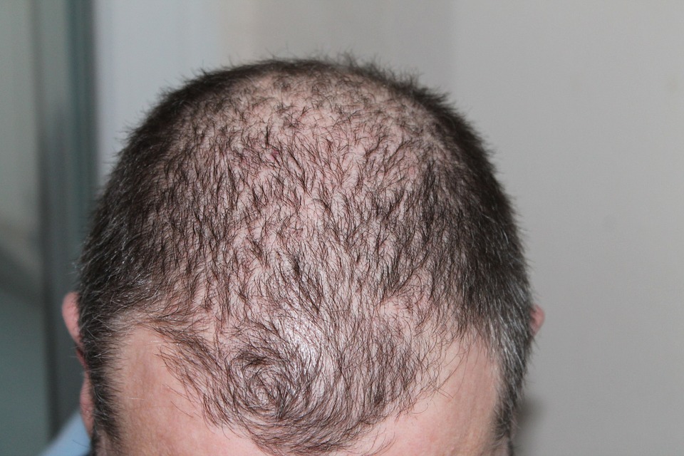 Haartransplantation ohne Rasieren
